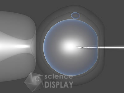 ICSI - Intracytoplasmic sperm injection 